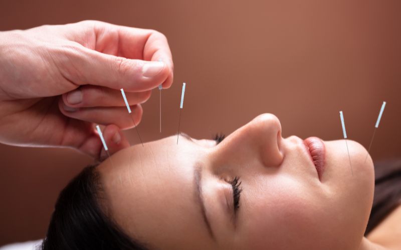 The Benefits of Acupuncture for Overall Wellness